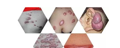 小疙瘩連成疙瘩片，疤痕為什么會越變越大？