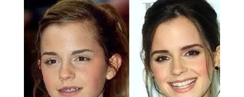 原本健康的牙齒需要拔掉進(jìn)行矯正嗎?