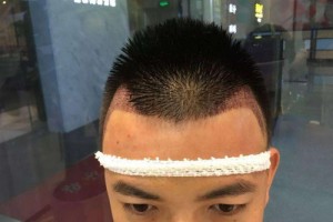 鄭州隴海醫(yī)院毛發(fā)移植中心整形價格表及醫(yī)院介紹