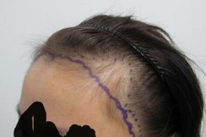 遼寧東方醫(yī)藥研究院臨床醫(yī)院植發(fā)中心怎么樣附全新價(jià)格表(價(jià)目表)