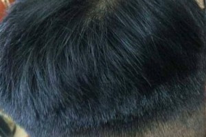 重慶騎士醫(yī)院植發(fā)中心怎么樣附全新價格表(價目表)