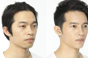 重慶真伊醫(yī)院毛發(fā)種植中心怎么樣附全新價格表(價目表)