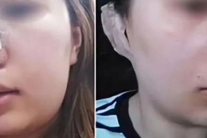 韓國ROOT毛發(fā)移植中心怎么樣附全新價格表(價目表)