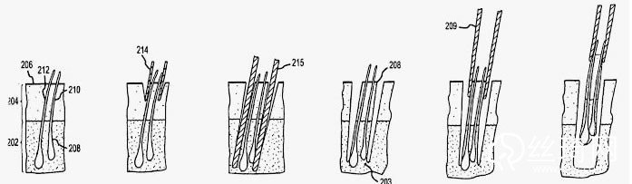 合肥維多利亞植發(fā)過(guò)程演示