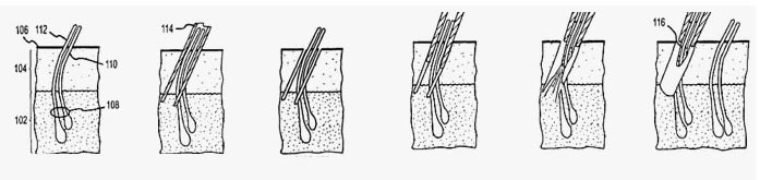 普通植發(fā)過(guò)程演示