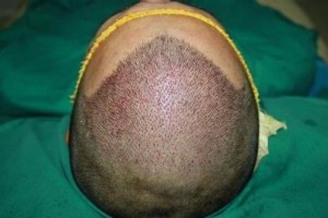 無錫百年植發(fā)醫(yī)院整形價格表(價目表)2020全新發(fā)布