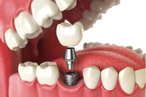 2020沈陽冠齒口腔醫(yī)院整形價格表(價目表)全新發(fā)布