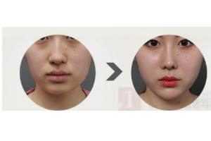 什么是頦部填充術(shù)，如何快速消腫