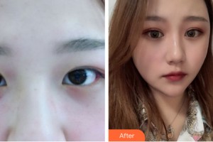 海南伊佳醫(yī)療美容醫(yī)院丁合軍整形價格表附眼部手術(shù)案例展示