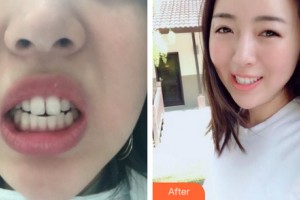 沈陽金皇后整形美容醫(yī)院管宇整形價格表附牙齒矯正案例展示