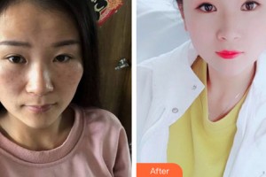 西安光仁醫(yī)院愛(ài)斯丁整形中心劉春華整形價(jià)格表附皮膚美容案例展示