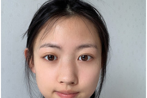 昆明市大陸醫(yī)療美容診所陸龍庭整形價(jià)格表附膨體隆鼻案例展示