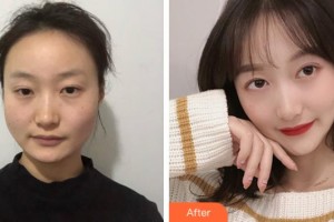 上海美之源整形外科醫(yī)院陳乃理整形價(jià)格表附下頜角磨骨案例展示