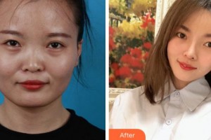 上海解放軍第四五五醫(yī)院激光整形科歸來(lái)整形價(jià)格表附臉型（顴骨+下頜角）+鼻部手術(shù)案例展示