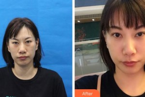 上海伊美爾港華醫(yī)療美容醫(yī)院張毅整形價(jià)格表附眼部綜合案例展示