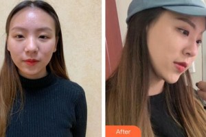 廣州現(xiàn)代醫(yī)院數(shù)字化整形美容中心劉志剛整形價(jià)格表附自體肋軟骨隆鼻案例展示