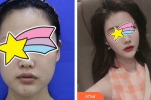 廣州軍頤醫(yī)院整形美容中心官小書整形價(jià)格表附面部脂肪填充案例展示