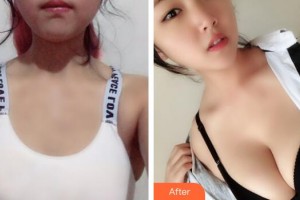 廣州軍頤醫(yī)院整形美容中心楊彥清整形價(jià)格表附濃縮豐胸案例展示