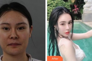 廣州軍區(qū)總醫(yī)院全軍激光整形美容中心余文林整形價(jià)格表附下頜角整形案例展示