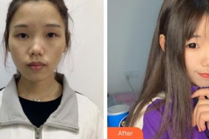 廣州軍區(qū)總醫(yī)院全軍激光整形美容中心程飚整形價(jià)格表附超激光美膚案例展示