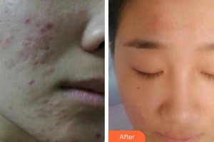 廣州軍區(qū)總醫(yī)院全軍激光整形美容中心苑凱華整形價(jià)格表附激光祛痘坑痘印案例展示