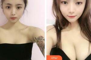 廣州遠(yuǎn)東美容醫(yī)院王魁然 教授整形價(jià)格表附內(nèi)窺鏡雙平面假體隆胸案例展示