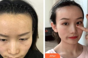 廣州醫(yī)學(xué)院第二附屬醫(yī)院整形美容中心楊志強(qiáng)整形價(jià)格表附發(fā)際線種植案例展示