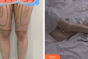 廣州星團(tuán)醫(yī)學(xué)美容門診部顧鵬整形價(jià)格表附大腿吸脂案例展示