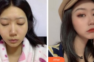 上海仁愛(ài)醫(yī)院整形美容科樸宰鉉韓國(guó)頭面部整形專家整形價(jià)格表附顴骨內(nèi)推案例展示