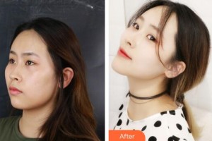 廣州壹加壹美容醫(yī)院河?xùn)|鎬整形價(jià)格表附面部吸脂瘦臉術(shù)案例展示