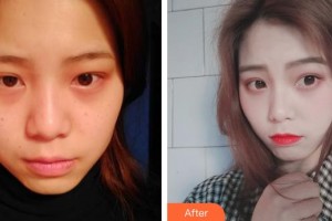 上海仁愛醫(yī)院整形美容科孫海榮有經(jīng)驗(yàn)激光美容專家整形價(jià)格表附激光美膚激光案例展示