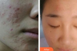 上海仁愛醫(yī)院整形美容科馬艷整形價(jià)格表附激光祛痘坑痘印案例展示