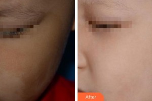 上海仁濟(jì)醫(yī)院整形外科邰寧正整形價(jià)格表附超激光美膚祛咖啡斑案例展示