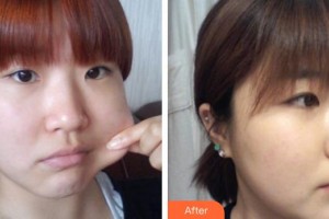 上海時(shí)光整形外科醫(yī)院趙紅梅整形價(jià)格表附面部吸脂案例展示