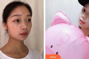 廣州曙光醫(yī)學(xué)美容醫(yī)院劉海峰整形價(jià)格表附水氧活膚案例展示