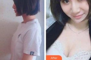 上海天大醫(yī)療美容醫(yī)院陳小偉整形價(jià)格表附假體隆胸案例展示
