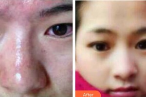 上海伊美爾港華醫(yī)療美容醫(yī)院楊凌飛整形價(jià)格表附光子嫩膚案例展示