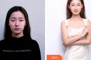 上海華美醫(yī)療美容醫(yī)院田波整形價(jià)格表附法國青春動(dòng)能素補(bǔ)水嫩膚，除皺案例展示