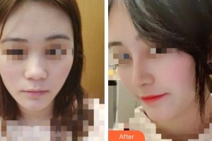 上海滬西醫(yī)院醫(yī)療美容科王春雨整形價(jià)格表附膨體+半肋軟骨案例展示