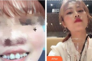 上海滬西醫(yī)院醫(yī)療美容科祖開慧整形價(jià)格表附隱形托槽案例展示