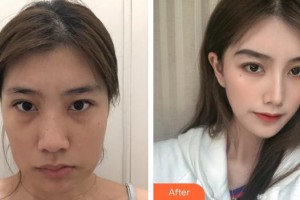 上海萬眾醫(yī)院醫(yī)療美容科文錦花整形價(jià)格表附下頜角切除案例展示