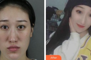 上海美立方整形醫(yī)院洪軍整形價格表附神奇的雙顎畸形矯正術(shù)案例展示