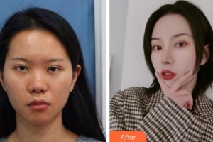 上海二醫(yī)大附屬第九人民醫(yī)院整形激光美容中心崔海燕整形價格表附假體隆鼻術(shù)案例展示