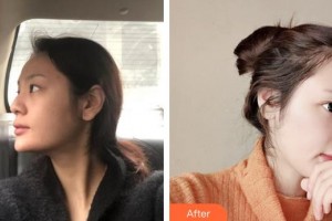 上海華美醫(yī)療美容醫(yī)院李庭勳整形價格表附鼻部手術(shù)脂肪填充案例展示