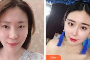 上海華美醫(yī)療美容醫(yī)院文愛克整形價格表附隆鼻手術(shù)日記案例展示