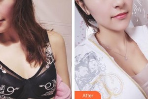 上海港華醫(yī)院浦東分院（悅?cè)葆t(yī)療美容診所）陳華生整形價格表附濃縮脂肪豐胸案例展示