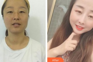 廣州華美醫(yī)療美容醫(yī)院丁彥整形價(jià)格表附白瓷案例展示