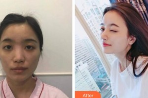 廣州曙光醫(yī)學(xué)美容醫(yī)院蔣思軍整形價(jià)格表附鼻部手術(shù)案例展示