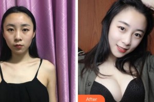 成都漢密爾頓美容醫(yī)院洪偉整形價格表附假體隆胸案例展示