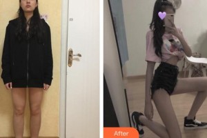 上海紐菲思醫(yī)療美容門診部朱維玲整形價格表附大腿吸脂案例展示